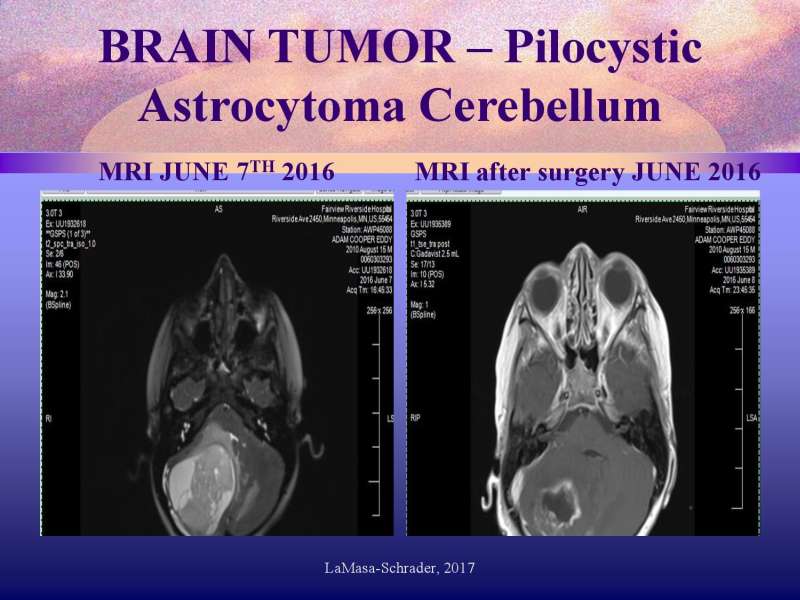 Emotional roots in Brain Cancers page 35